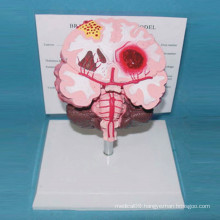 Pathological Human Brain Anatomical Model for Teaching and Demonstration